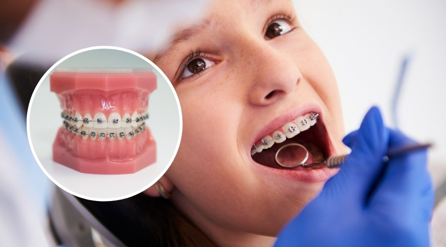 Braces Treatment in Gangtok