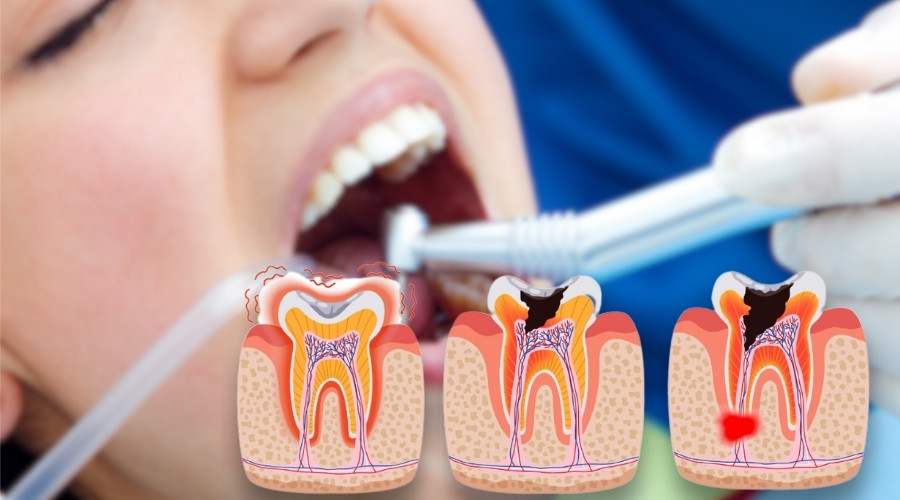 Root Canal Treatment in Gangtok 